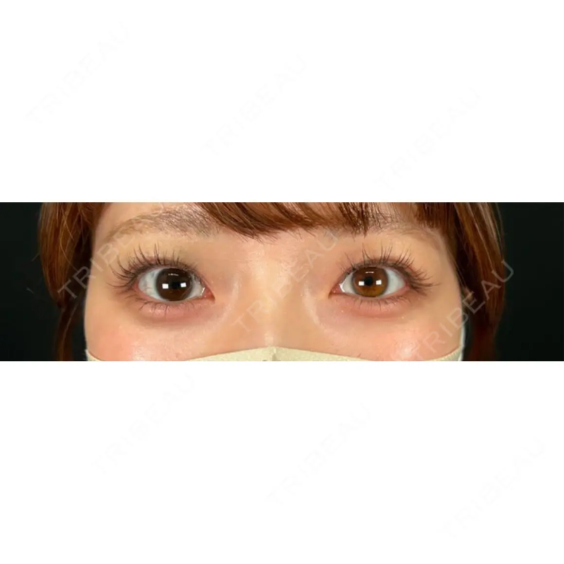 二重埋没 湘南美容クリニック 西葛西院 AFTER