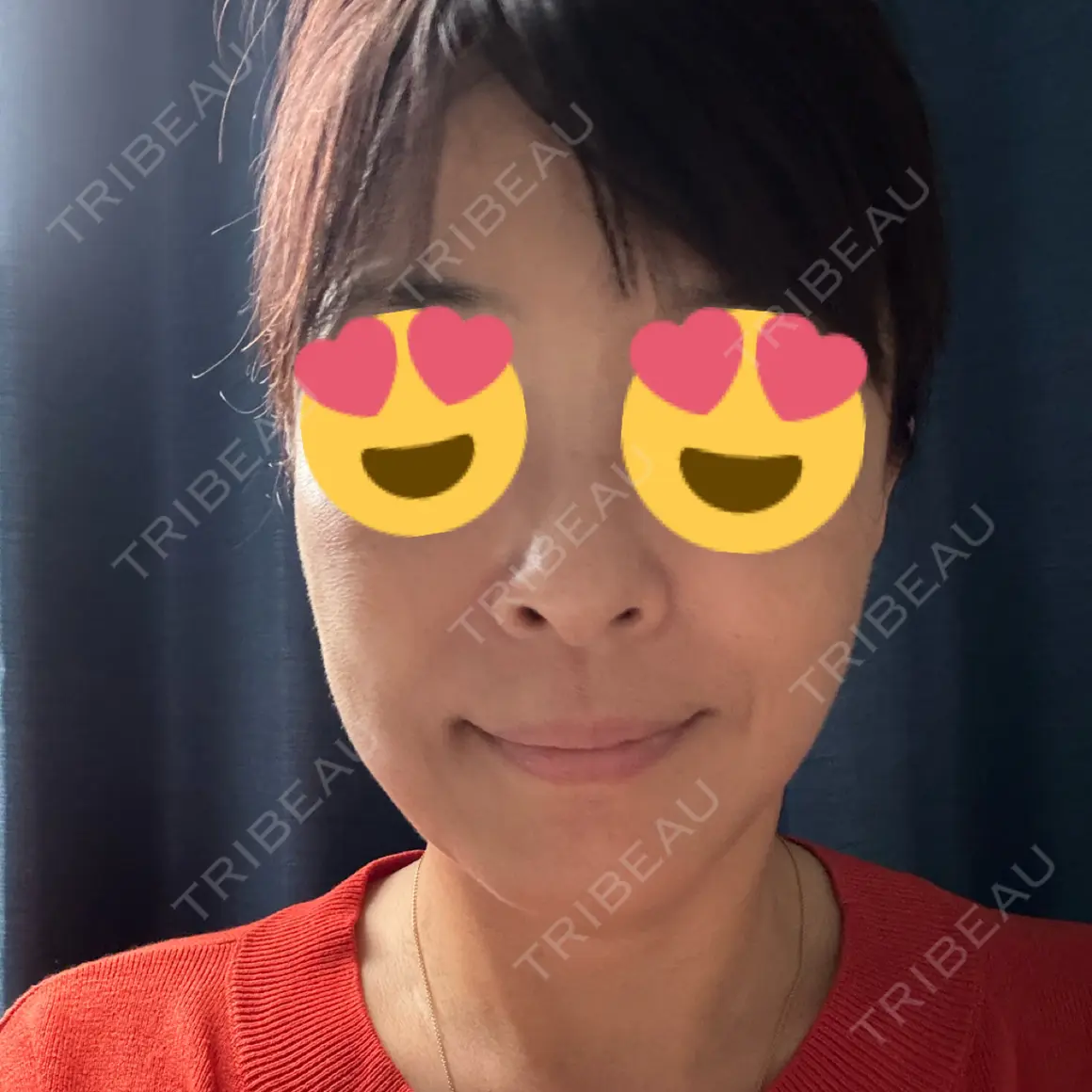 ハイフ（顔） ASTRA BEAUTY CLINIC AFTER