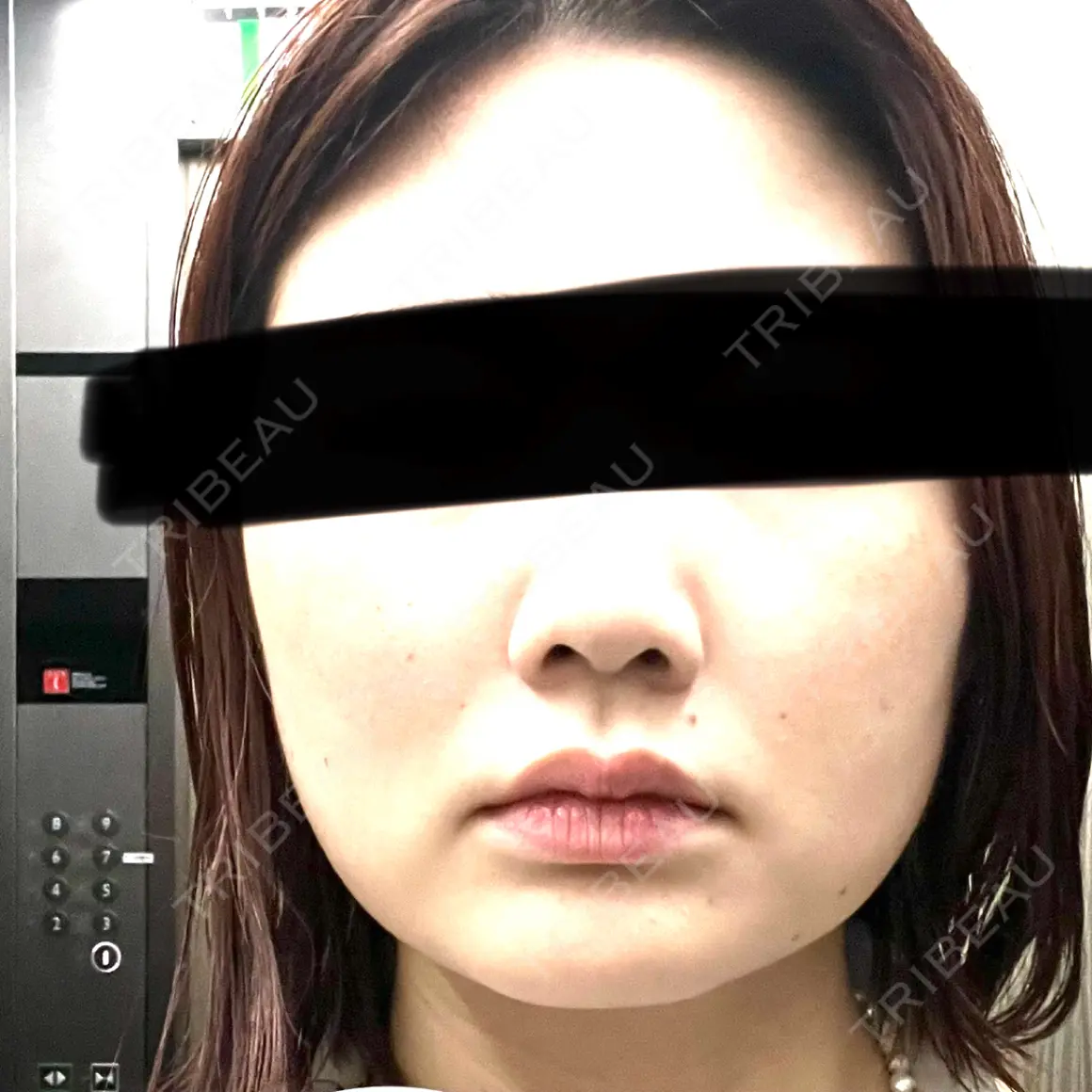 ボトックス（エラ・小顔） TCB東京中央美容外科 高田馬場院 DAY 0