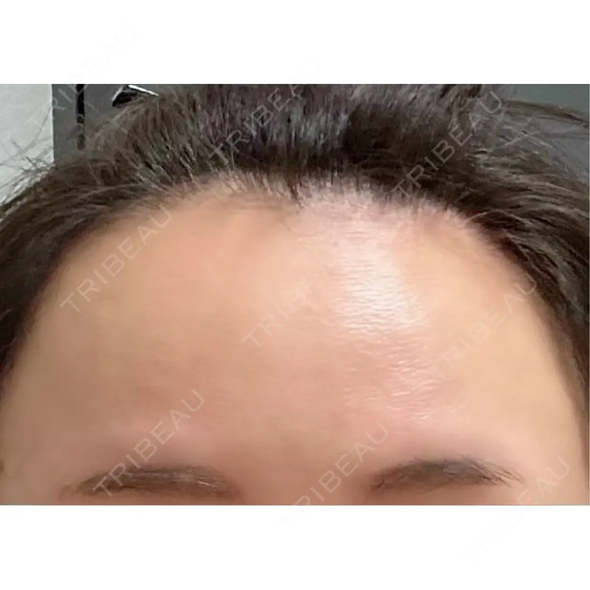 ボトックス（額） WellnessPlus Clinic 【ウェルネスプラスクリニック】 AFTER