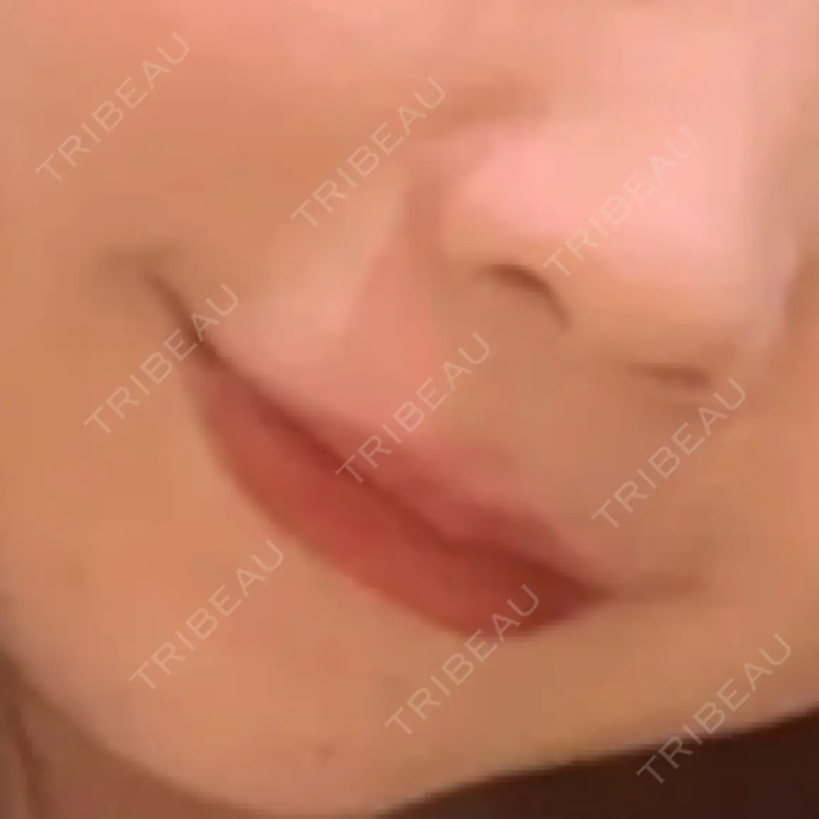 ヒアルロン酸注入（唇） HAAB×DREAM BEAUTY CLINIC 大阪梅田院 AFTER