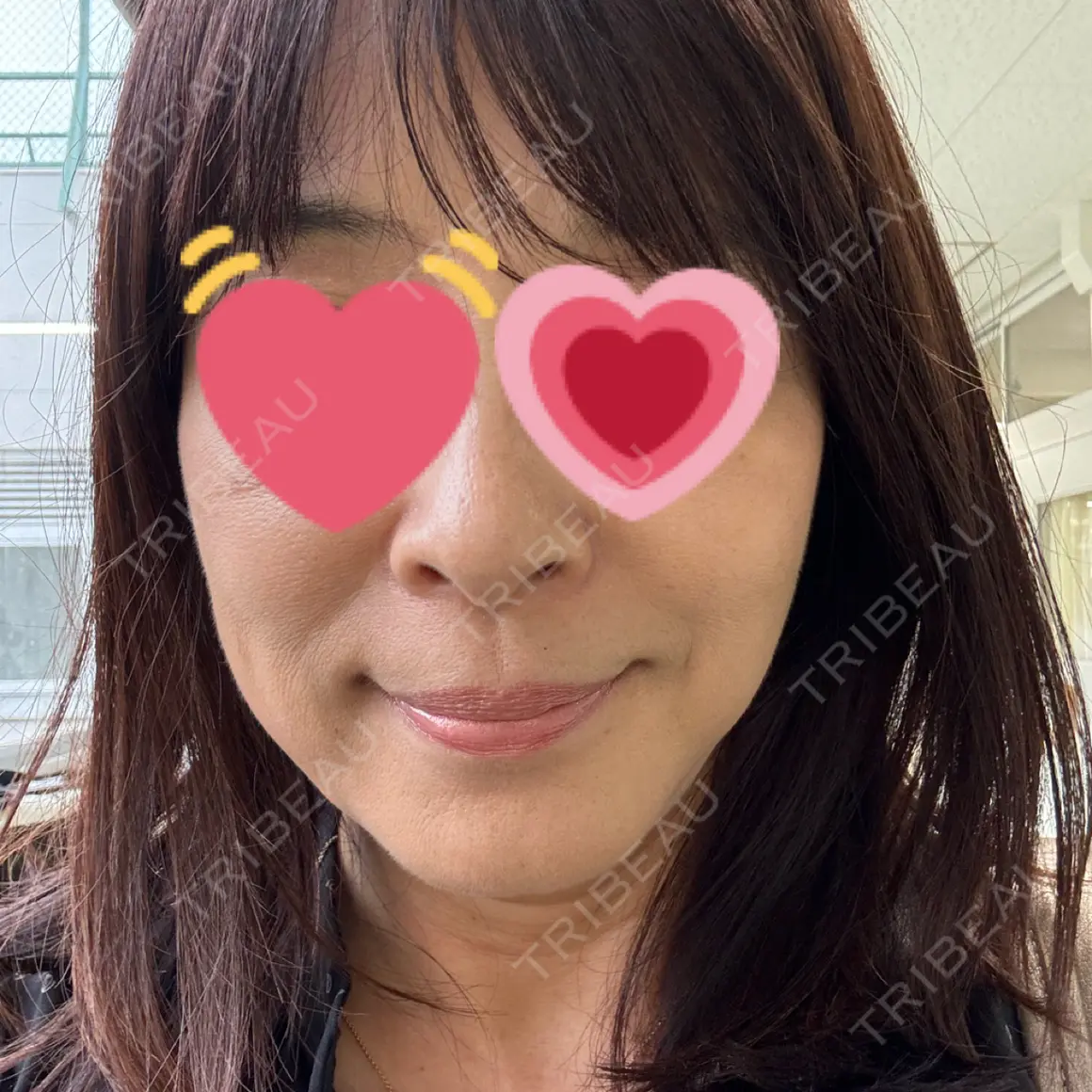 ハイフ（顔） ASTRA BEAUTY CLINIC AFTER