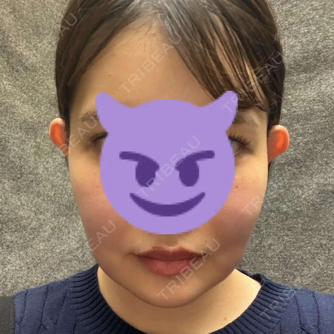 脂肪溶解注射（顔） KAGA CLINIC DAY 0