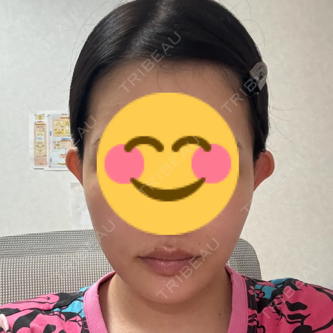 脂肪溶解注射（顔） KAGA CLINIC AFTER