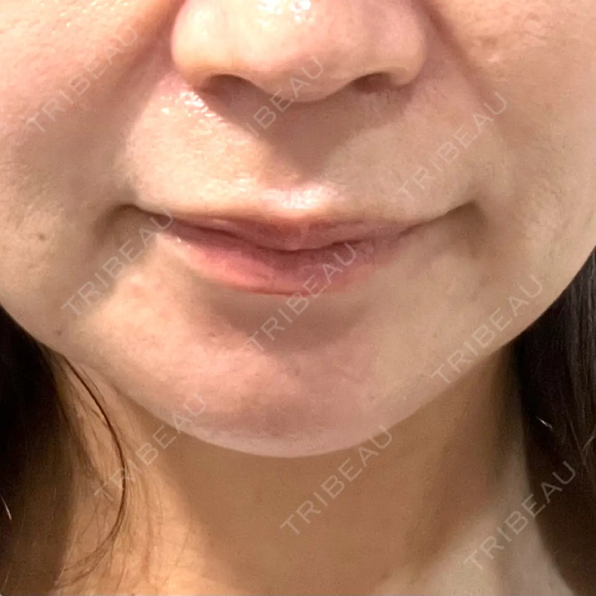 脂肪溶解注射（顔） LIF SKIN CLINIC DAY 0