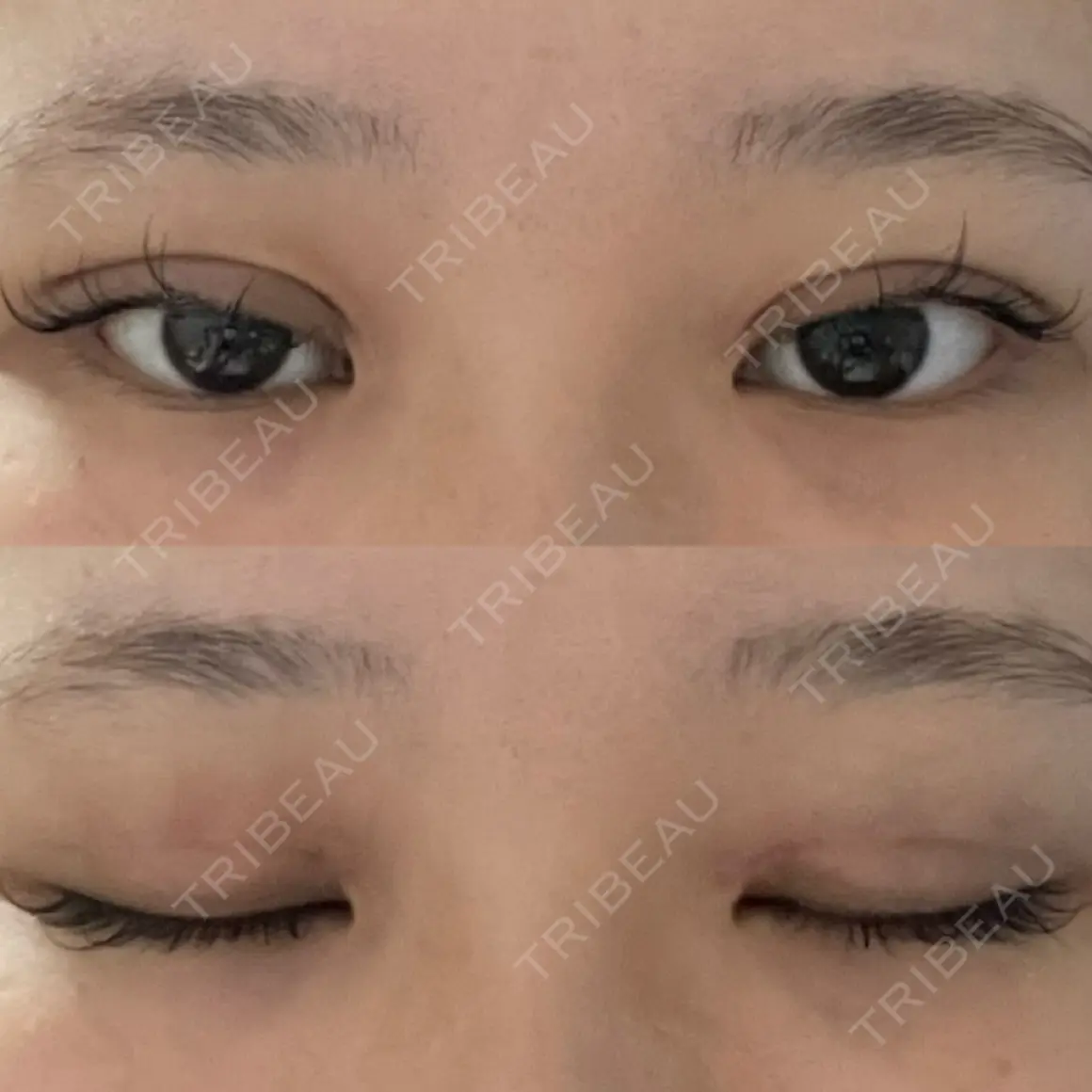 二重埋没 9BeautyClinic DAY 0