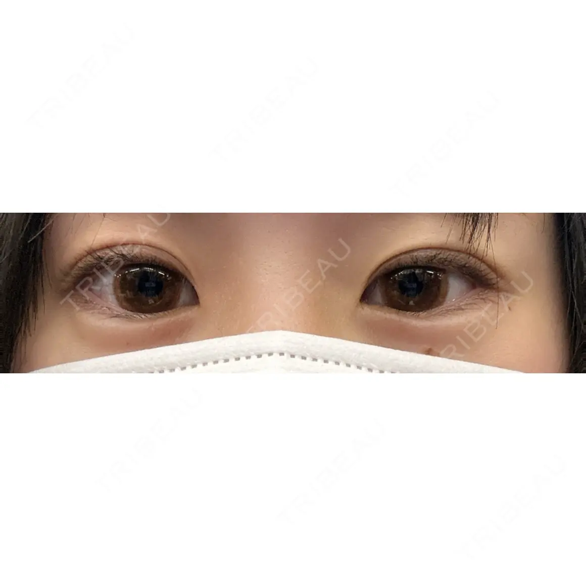 ヒアルロン酸注入（涙袋） AYANAフィラーズクリニック 渋谷院 DAY 0