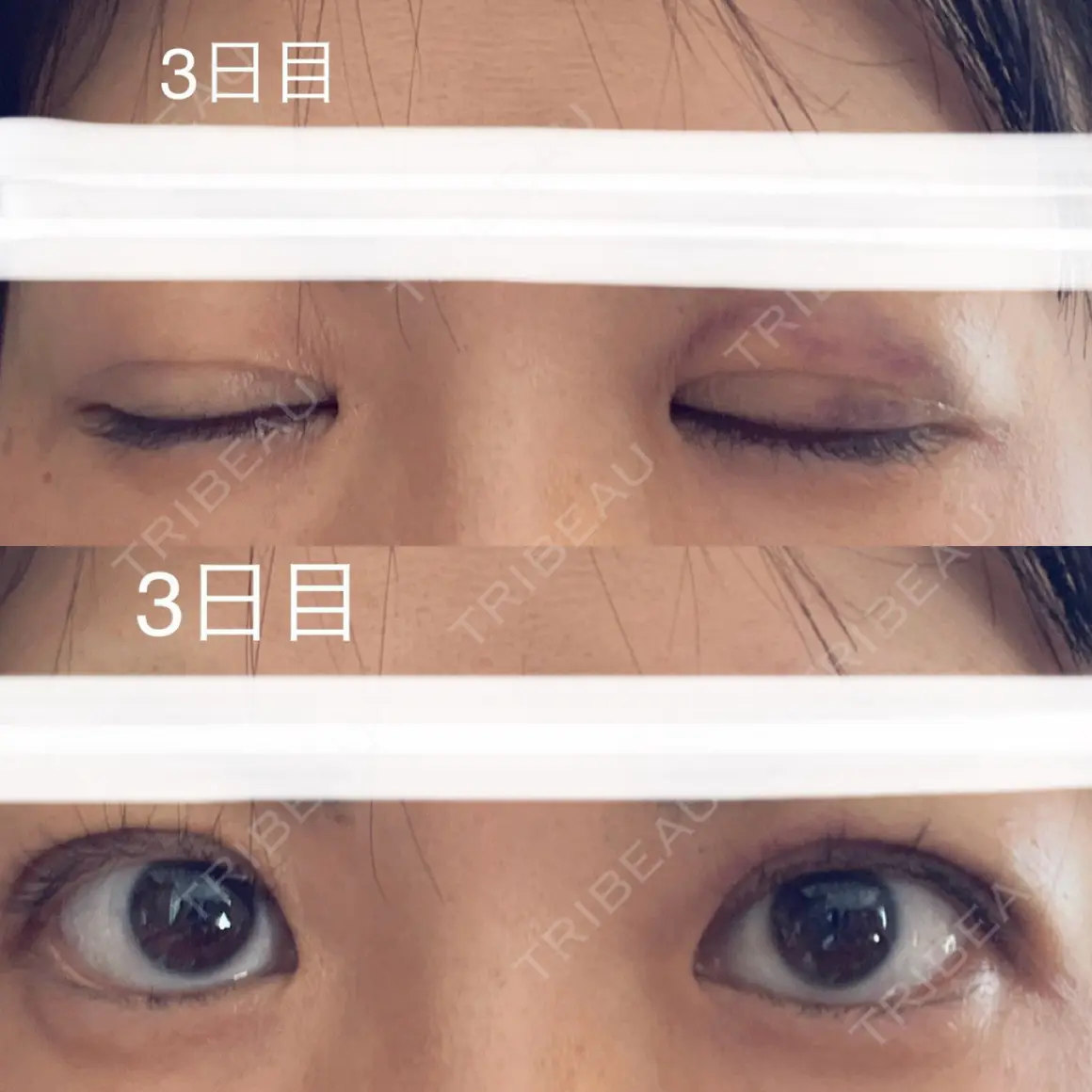 二重埋没 ルラ美容クリニック 神戸院 AFTER