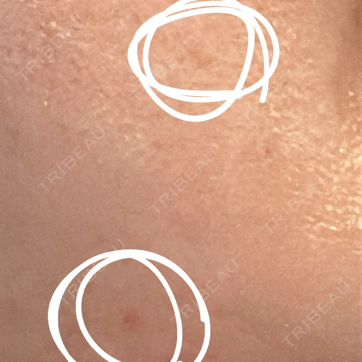 ほくろ・いぼ切除（肌） Jスキンクリニック 【J-SKIN clinic】 AFTER