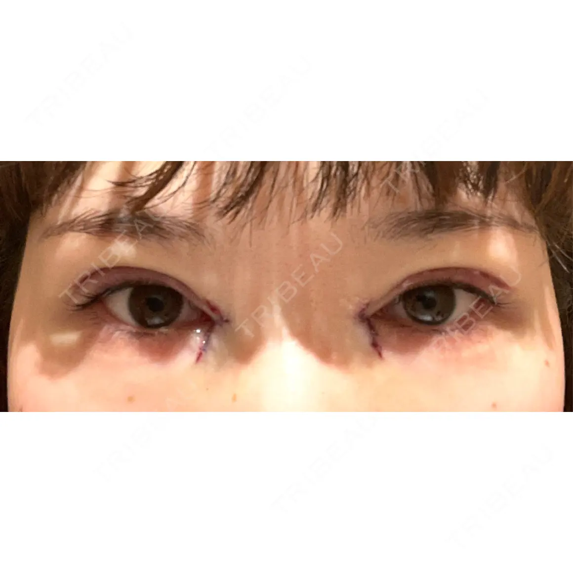 二重切開 / 目頭切開 銀座高須クリニック DAY 0