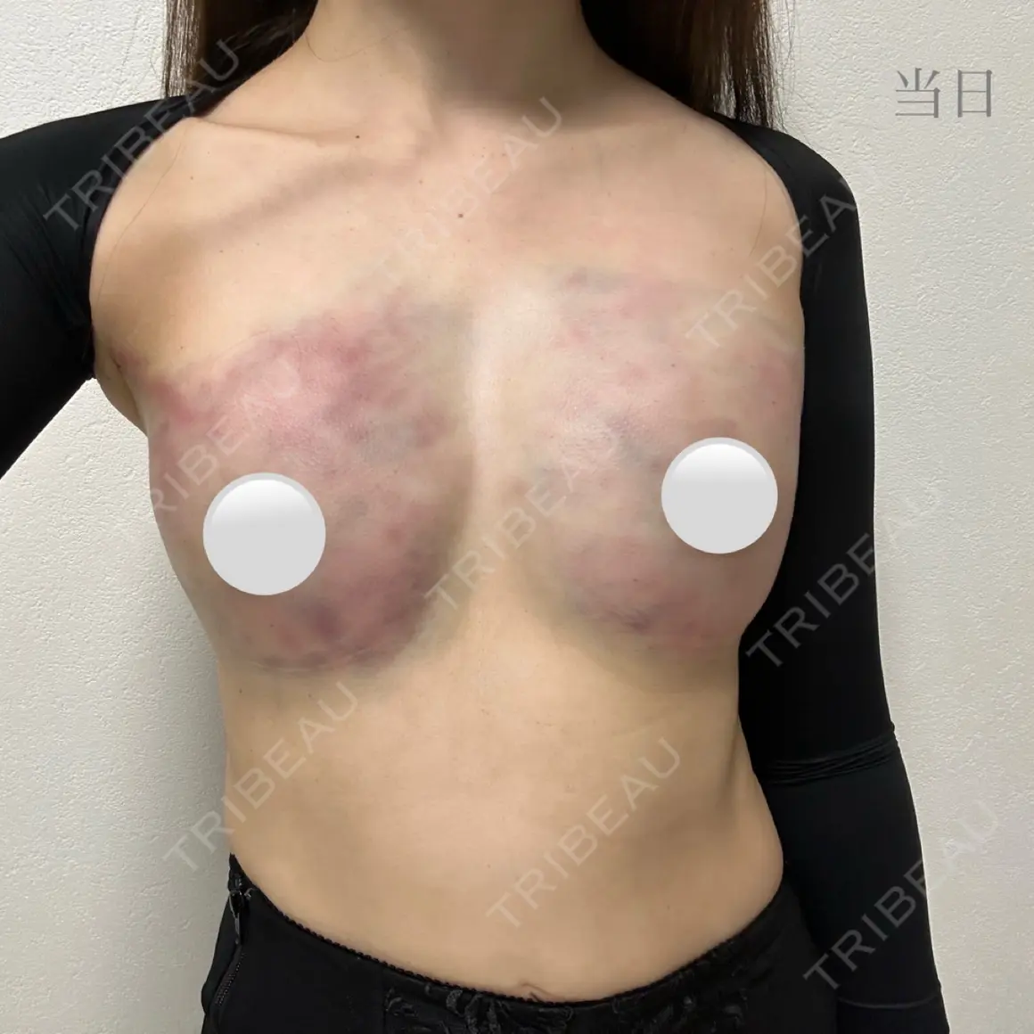 豊胸（脂肪注入） ARIEL.BUST.CLINIC DAY 0