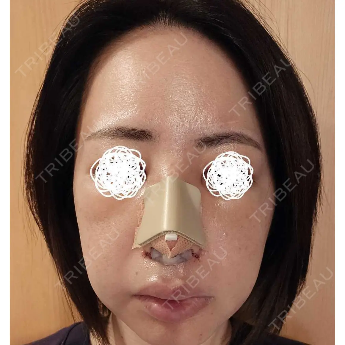 鼻尖形成（切開） / 小鼻縮小（切開） / 軟骨移植 / 骨切幅寄せ / ワシ鼻修正・ハンプ切除 銀座マイアミ美容外科 DAY 2