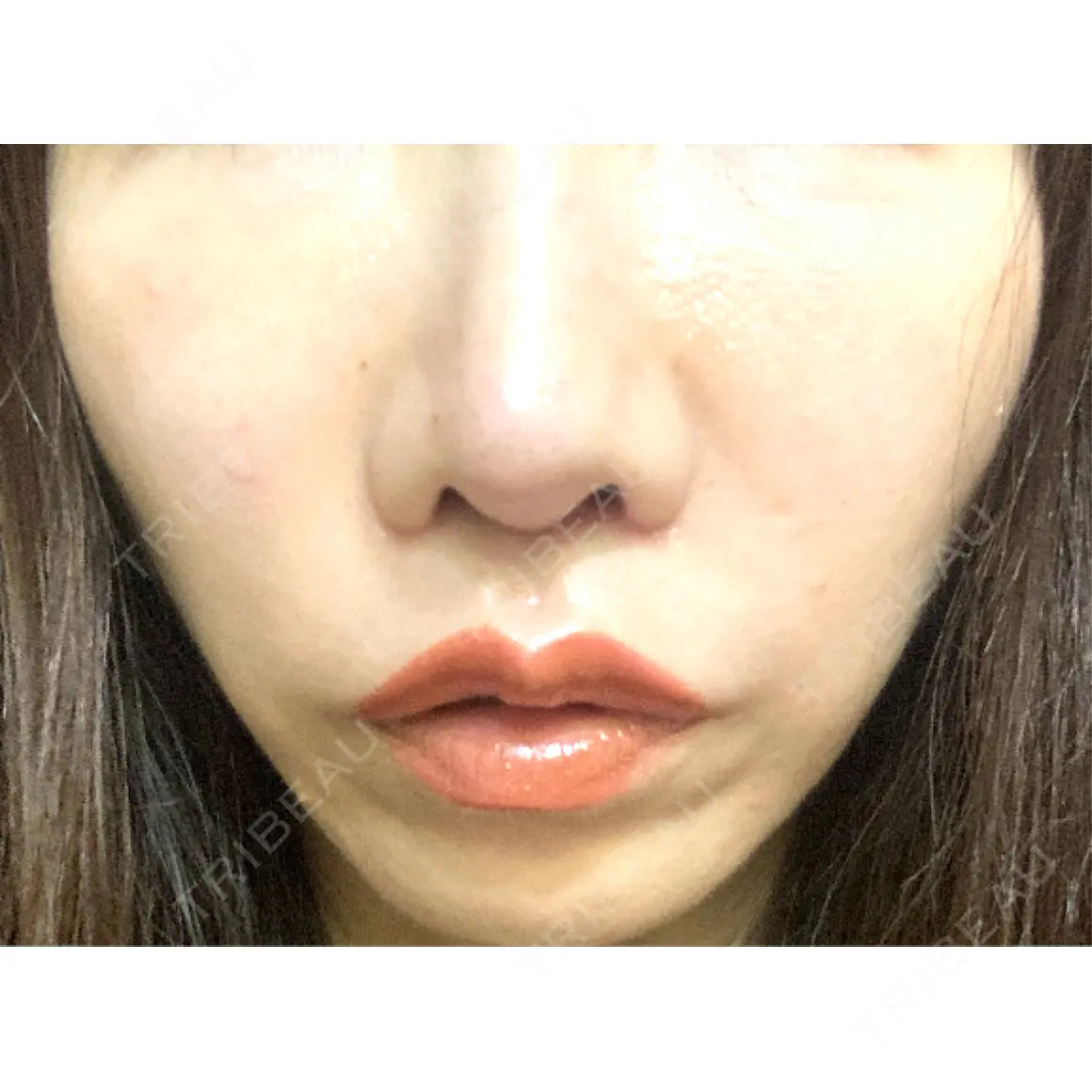 ヒアルロン酸注入（唇） / ボトックス（口角） おおたかの森ビューティークリニック AFTER