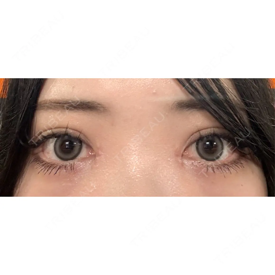 二重埋没 / 目頭切開 THE FIRST CLINIC 多摩センター院 AFTER