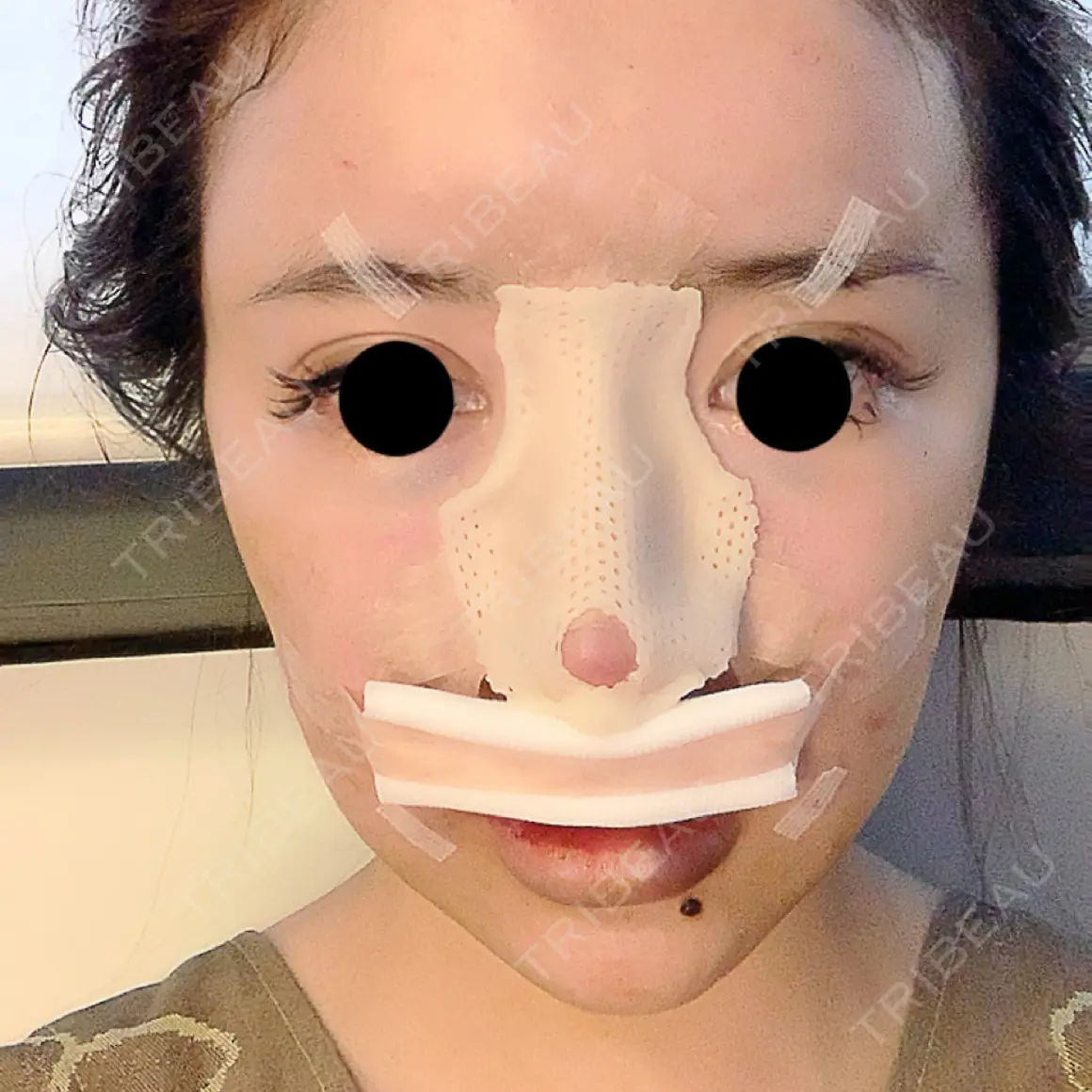 鼻尖形成（切開） / 鼻中隔延長（切開） / 脂肪注入（額） / 脂肪注入（輪郭） ビーザニュー美容整形外科（旧コノピ美容整形外科） DAY 0