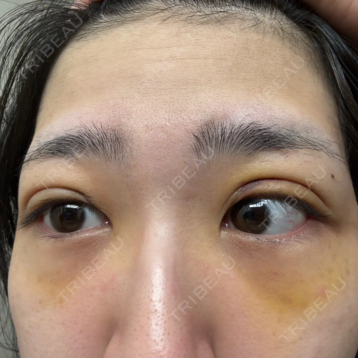 二重埋没 / クマ治療 湘南美容クリニック 西葛西院 DAY 5