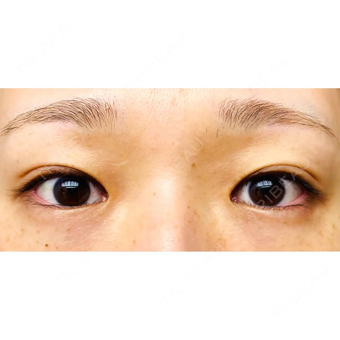 目頭切開 / 自然癒着法 / 眼瞼下垂（非切開） LUHO（ルホ）美容外科 AFTER