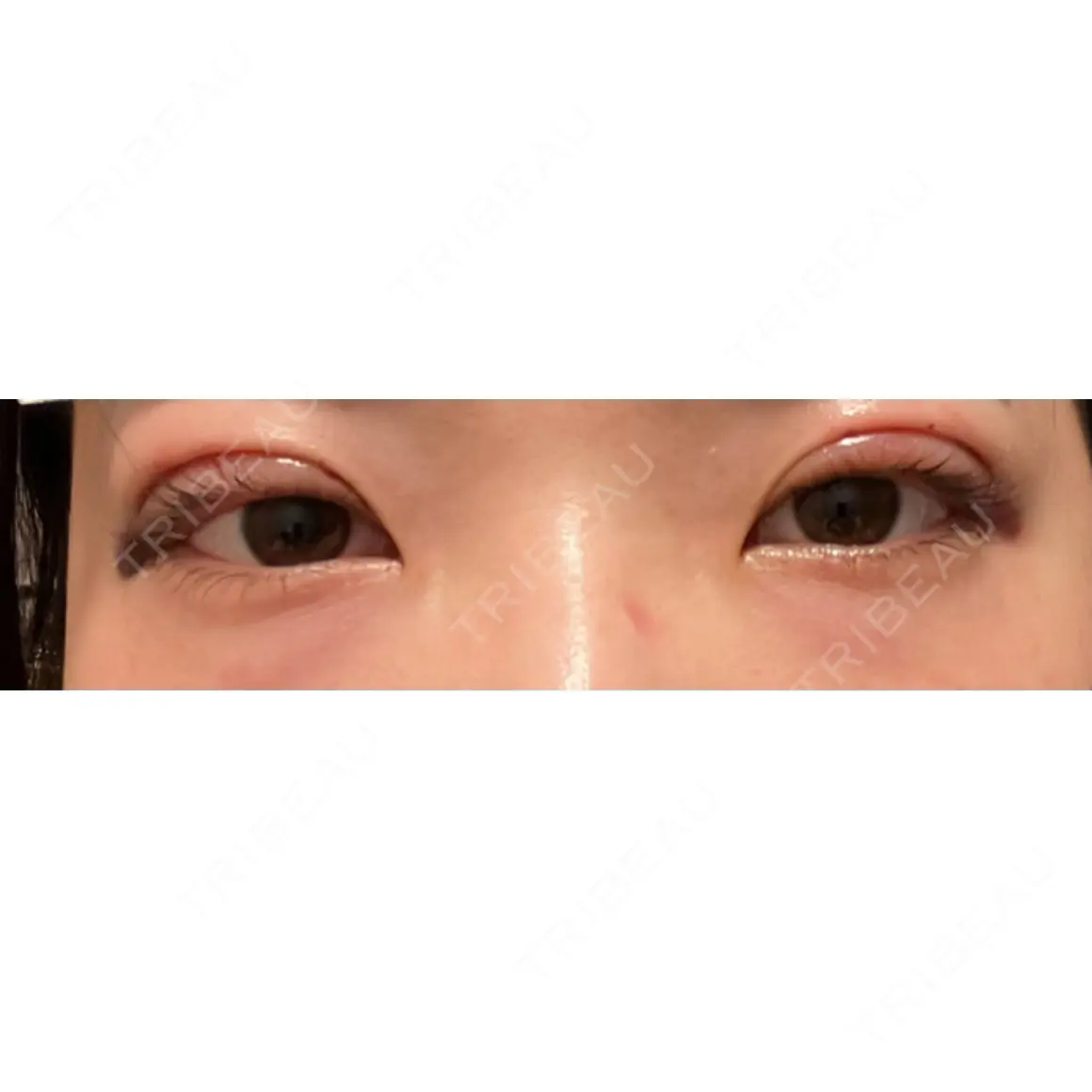 二重埋没 宇都宮竹内クリニック DAY 0