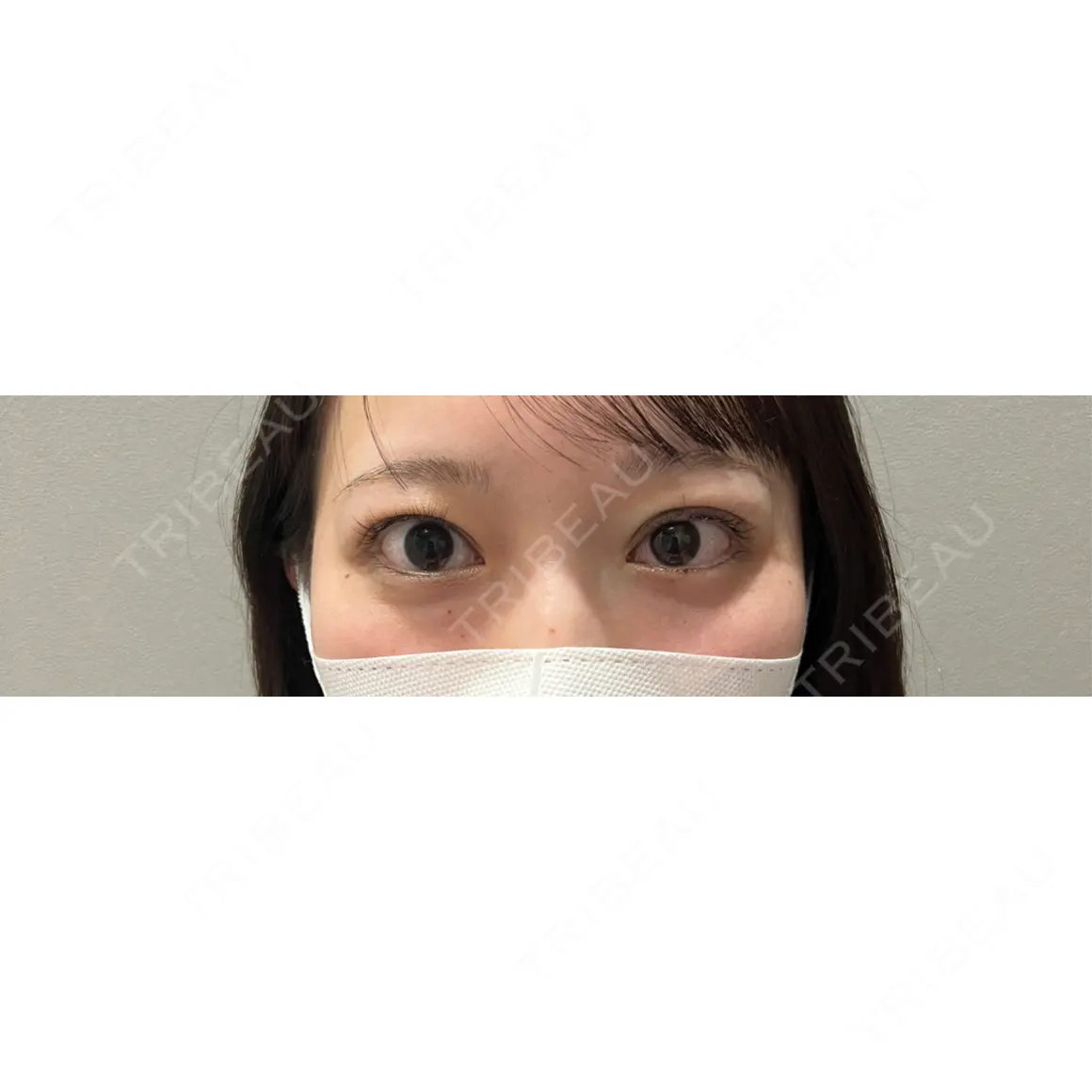 二重埋没 YBC横浜美容外科 大宮院 DAY 0