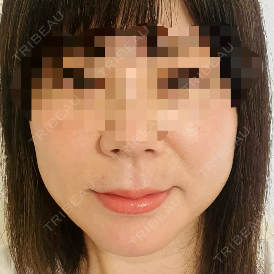 糸リフト 福岡TAクリニック AFTER