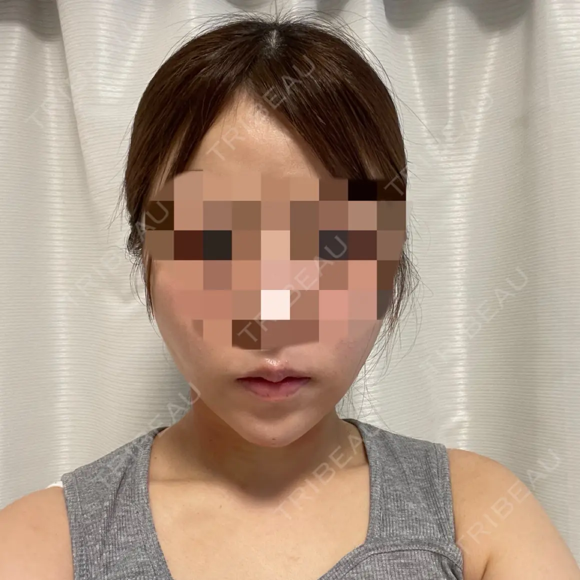糸リフト / 脂肪吸引（顔） / 脂肪注入（肌） / メーラーファット除去 湘南美容クリニック Regno 銀座院 DAY 1