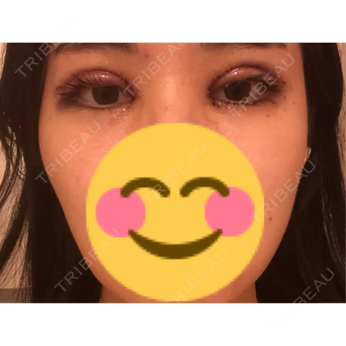 目頭切開 / 眼瞼下垂（切開） Otus Clinic 【オータスクリニック】 DAY 0