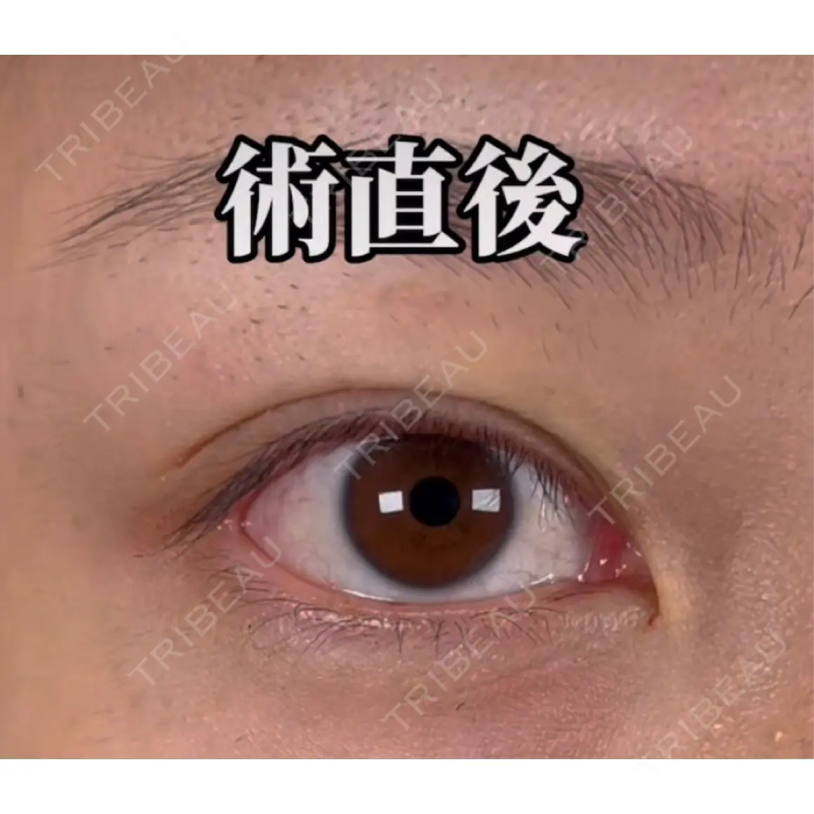 二重埋没 湘南美容クリニック 西葛西院 DAY 0