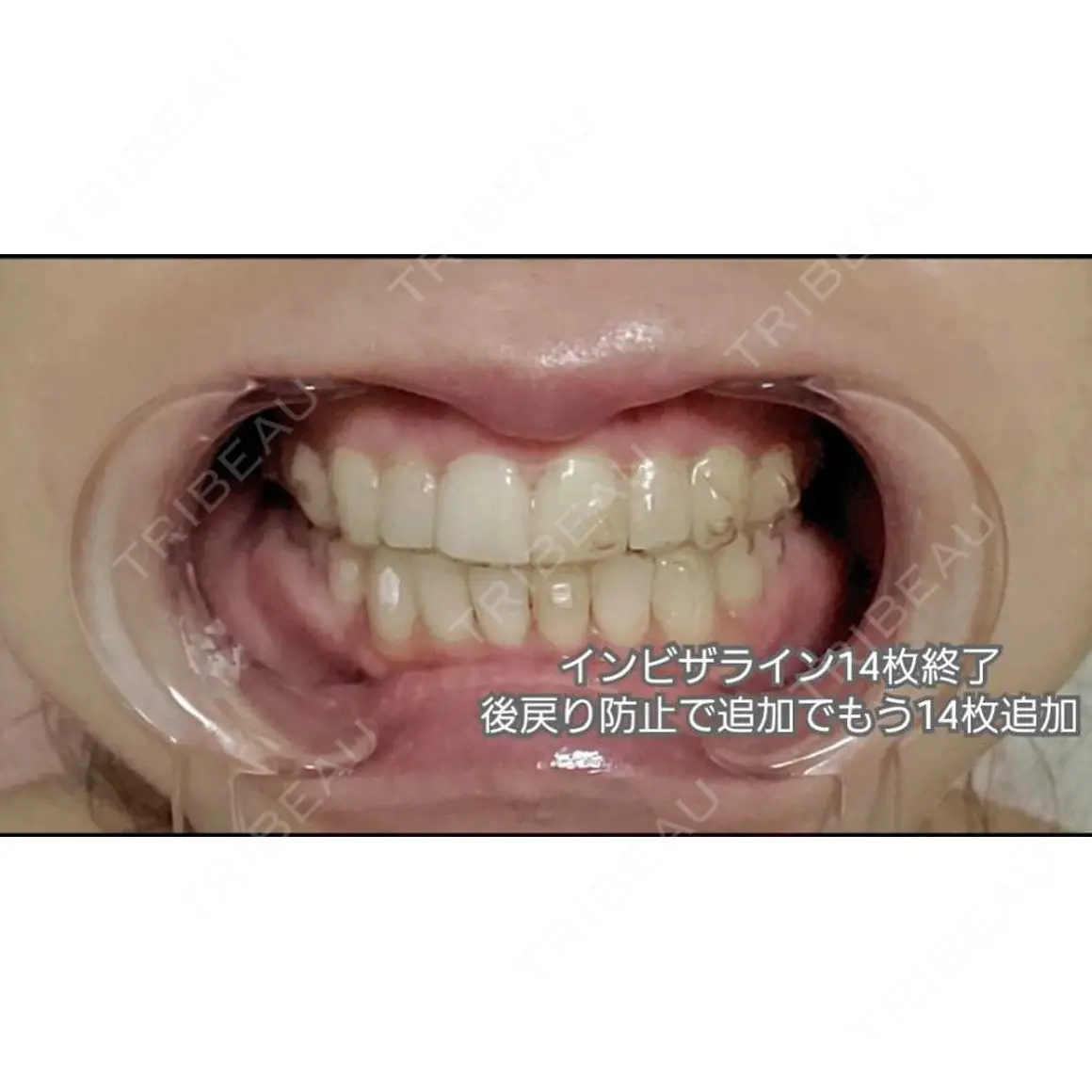 矯正（マウスピース） オーラルビューティークリニック クラリス審美歯科・矯正歯科 AFTER