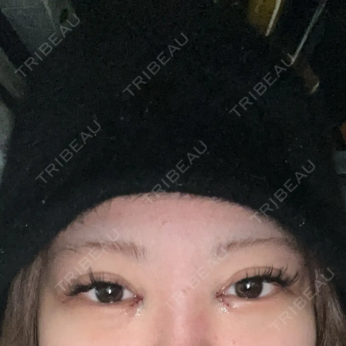 目頭切開 9BeautyClinic DAY 0
