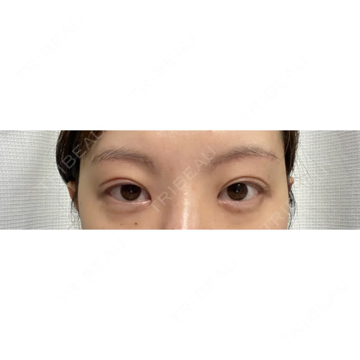 二重切開 / 目頭切開 / 上まぶたの脂肪取り / 眉下切開 タシピウム整形外科 DAY 37