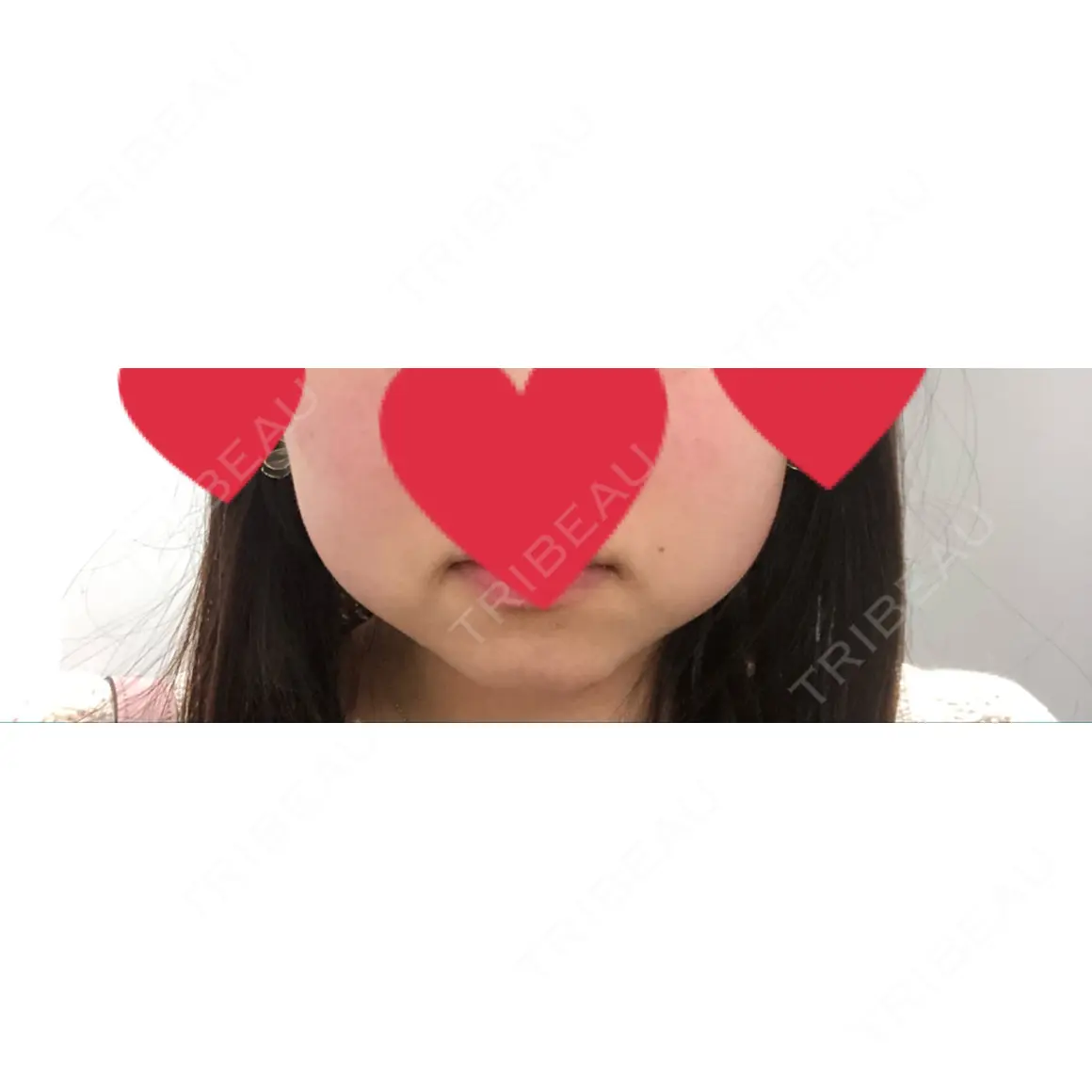 脂肪溶解注射（顔） 湘南美容クリニック 名古屋院 DAY 0