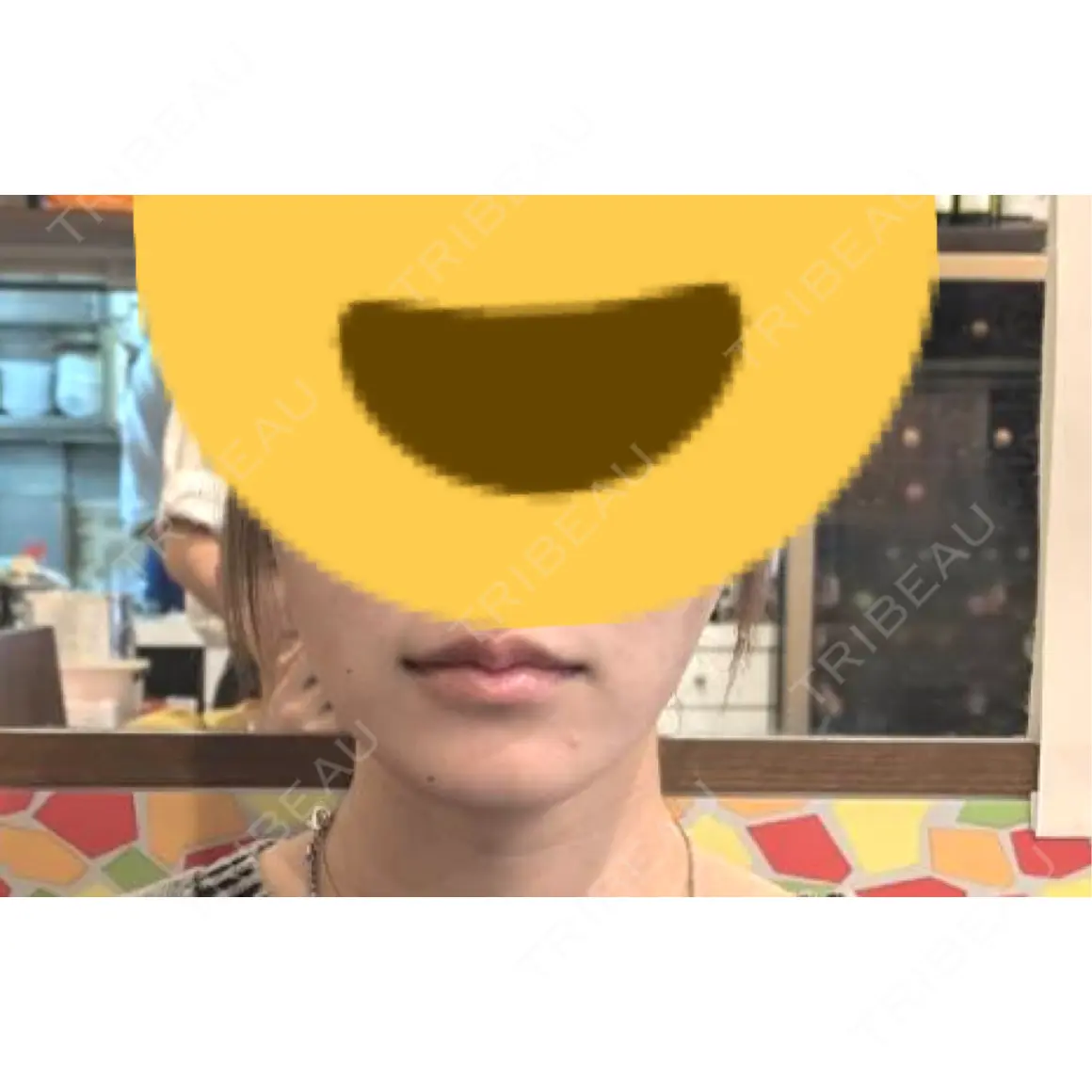 ヒアルロン酸注入（涙袋） / ヒアルロン酸注入（唇） / ボトックス（口角） おおたかの森ビューティークリニック AFTER