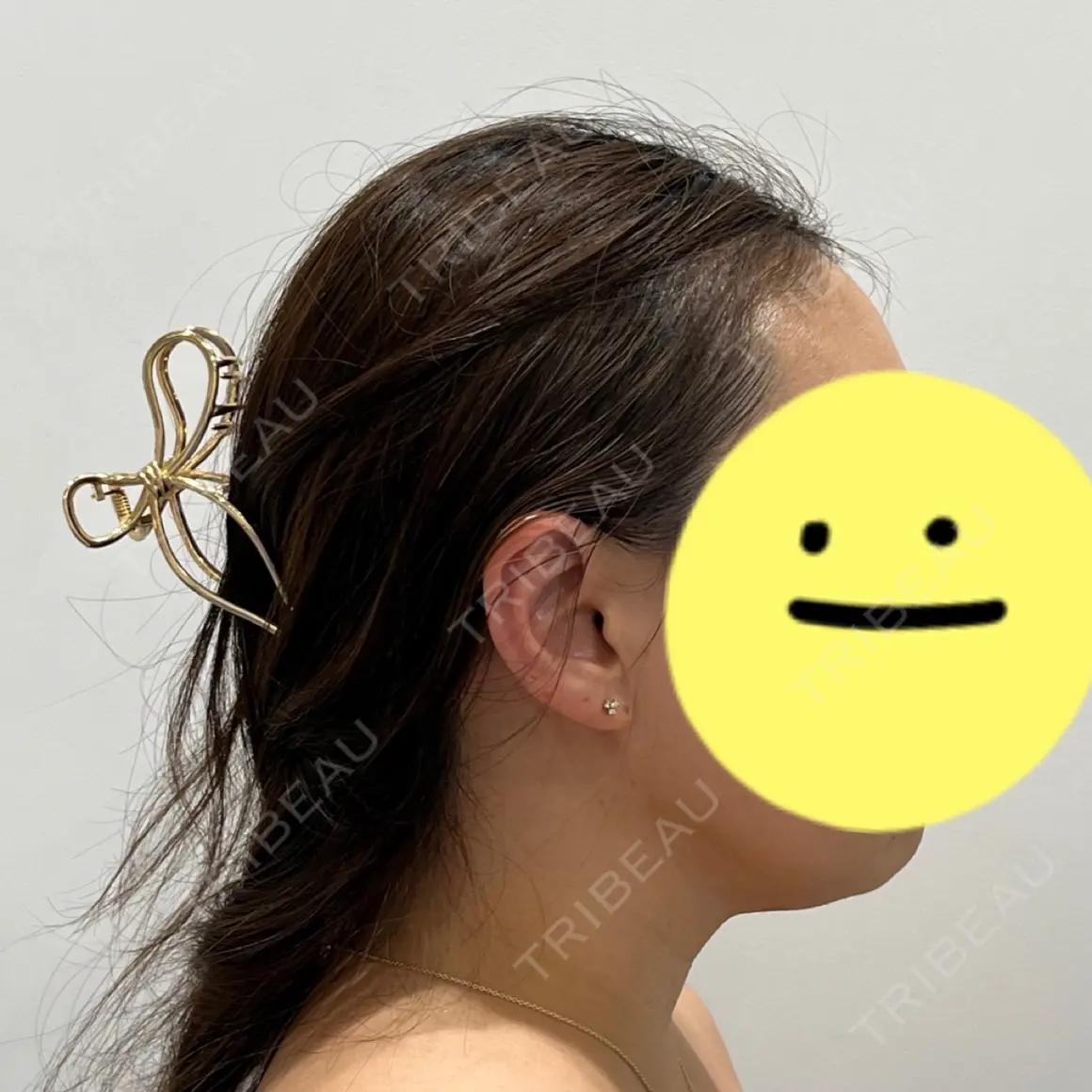 脂肪溶解注射（顔） / 脂肪溶解注射（二の腕） SK新宿歌舞伎町美容外科・歯科 AFTER