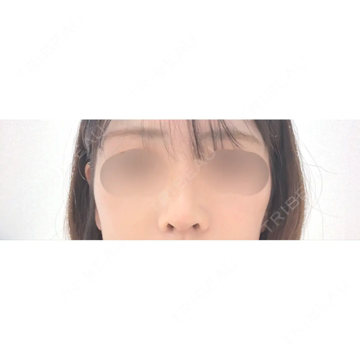 隆鼻術 / 鼻尖形成（切開） / 鼻中隔延長（切開） / 鼻翼基部形成（貴族手術） / 鼻柱下降・鼻唇角形成（猫手術） WOM CLINIC GINZA （ワム クリニック ギンザ） AFTER
