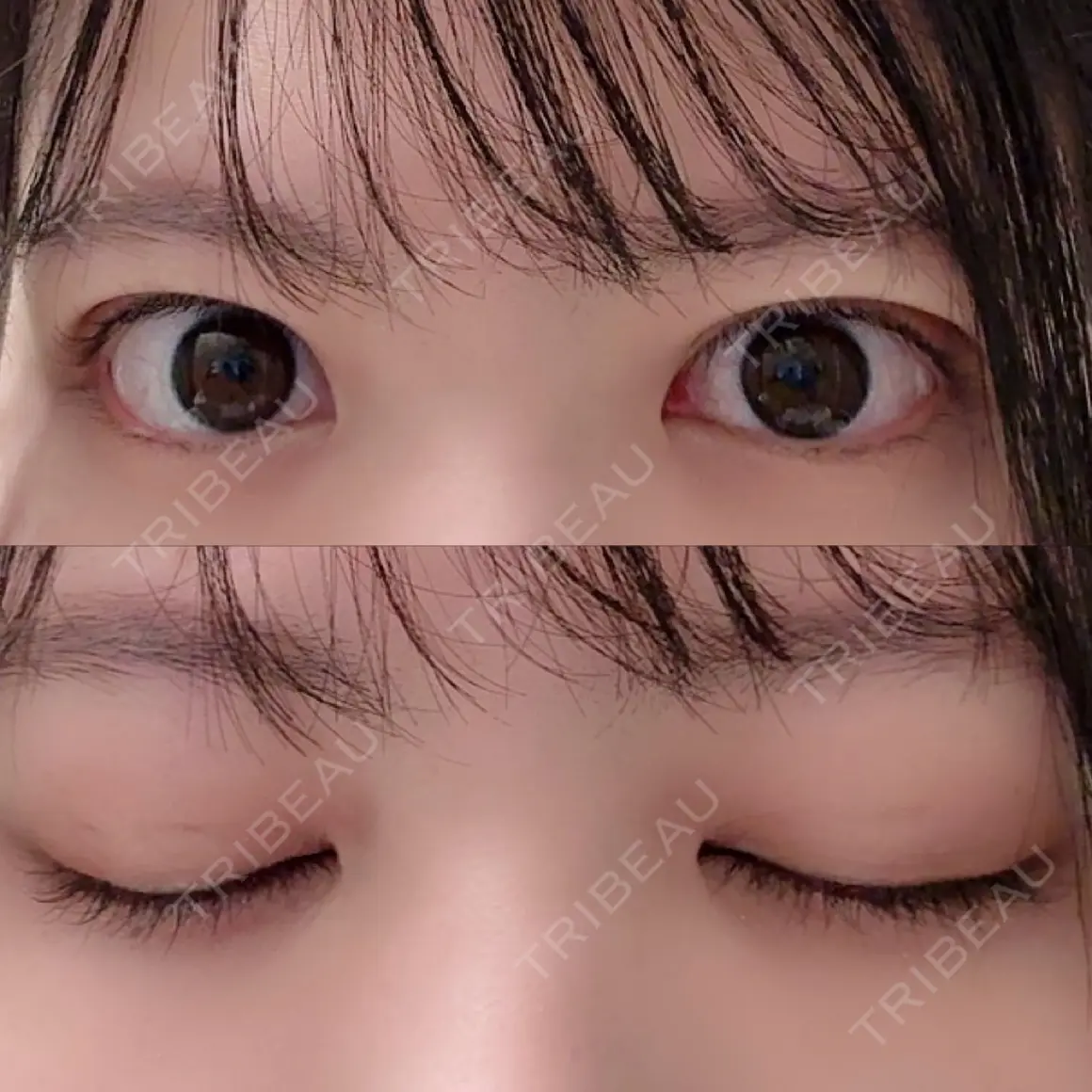 二重埋没 湘南美容クリニック 西葛西院 AFTER
