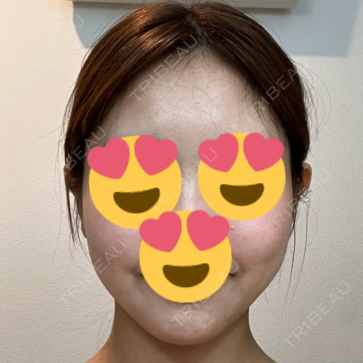 脂肪溶解注射（顔） WellnessPlus Clinic 【ウェルネスプラスクリニック】 DAY 0