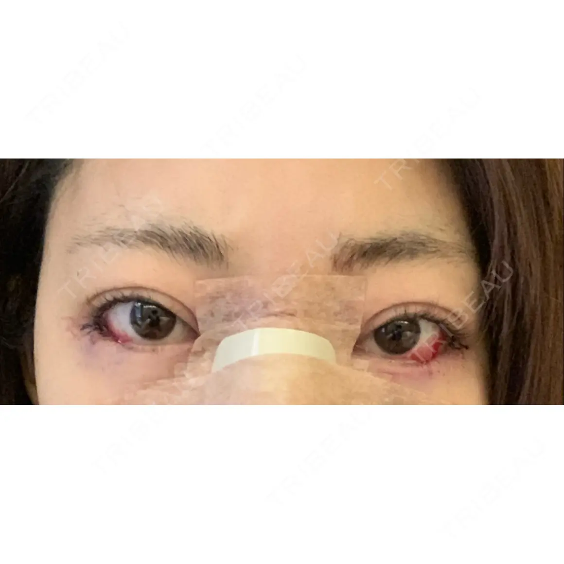 目尻切開 / タレ目形成・グラマラスライン（切開） NANA（ナナ）美容外科 DAY 0