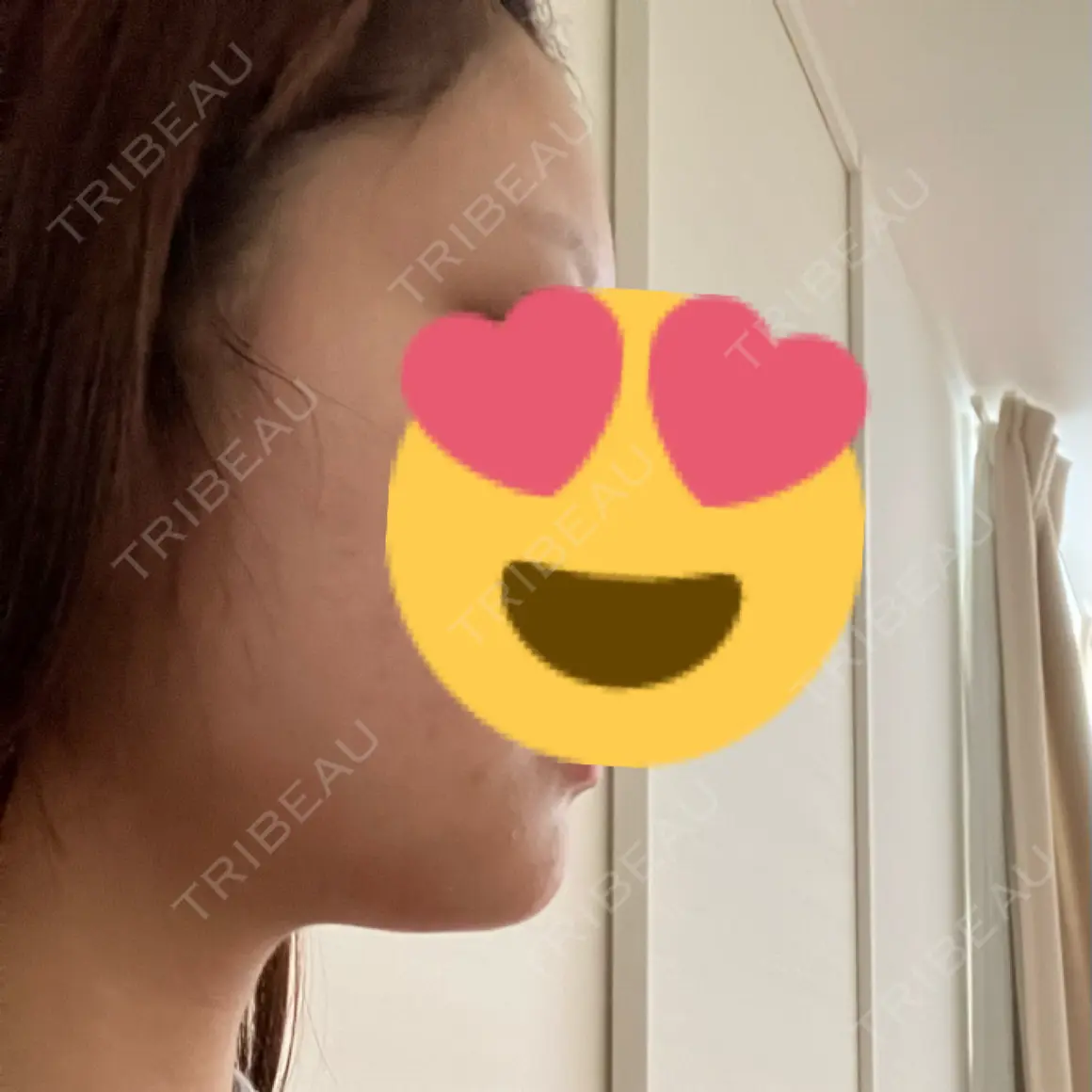 脂肪溶解注射（顔） WellnessPlus Clinic 【ウェルネスプラスクリニック】 AFTER