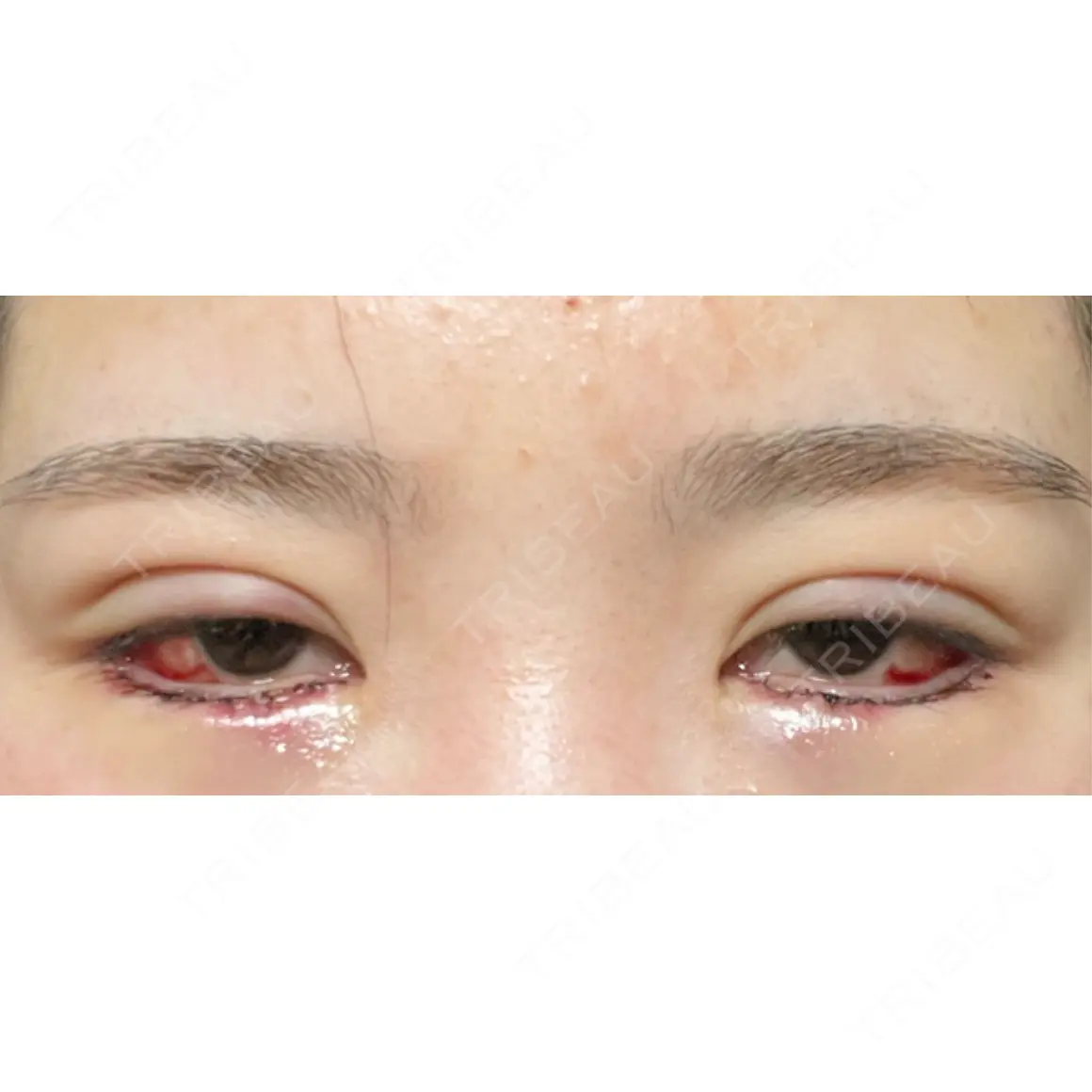 二重埋没 / タレ目形成・グラマラスライン（切開） エターナル美容クリニック DAY 0