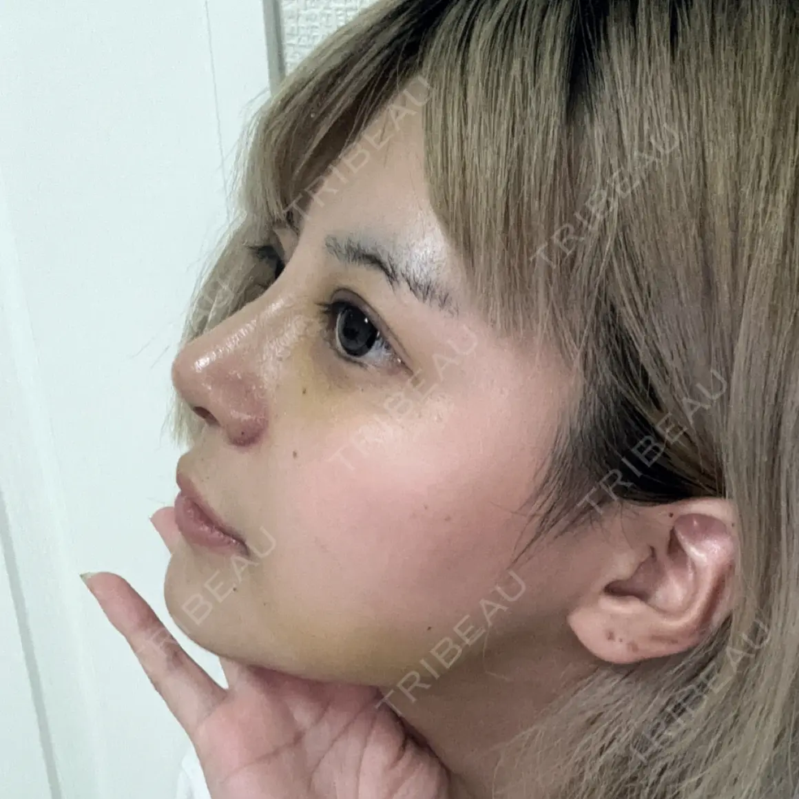 鼻尖形成（切開） / 鼻中隔延長（切開） / 軟骨移植 / 骨切幅寄せ / ワシ鼻修正・ハンプ切除 WOM CLINIC GINZA （ワム クリニック ギンザ） AFTER