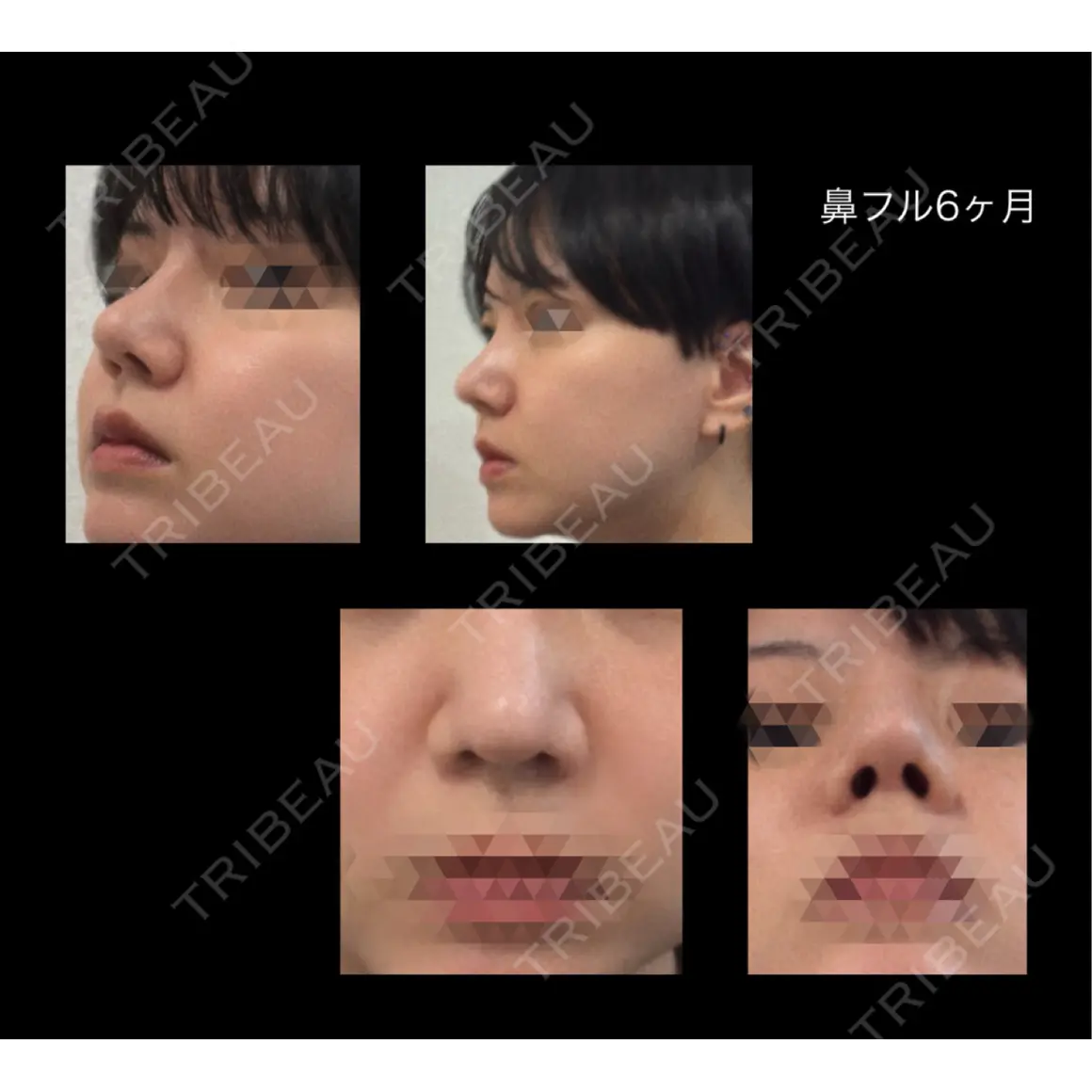 隆鼻術 / 鼻尖形成（切開） / 鼻中隔延長（切開） / 骨切幅寄せ / ワシ鼻修正・ハンプ切除 LUHO（ルホ）美容外科 AFTER