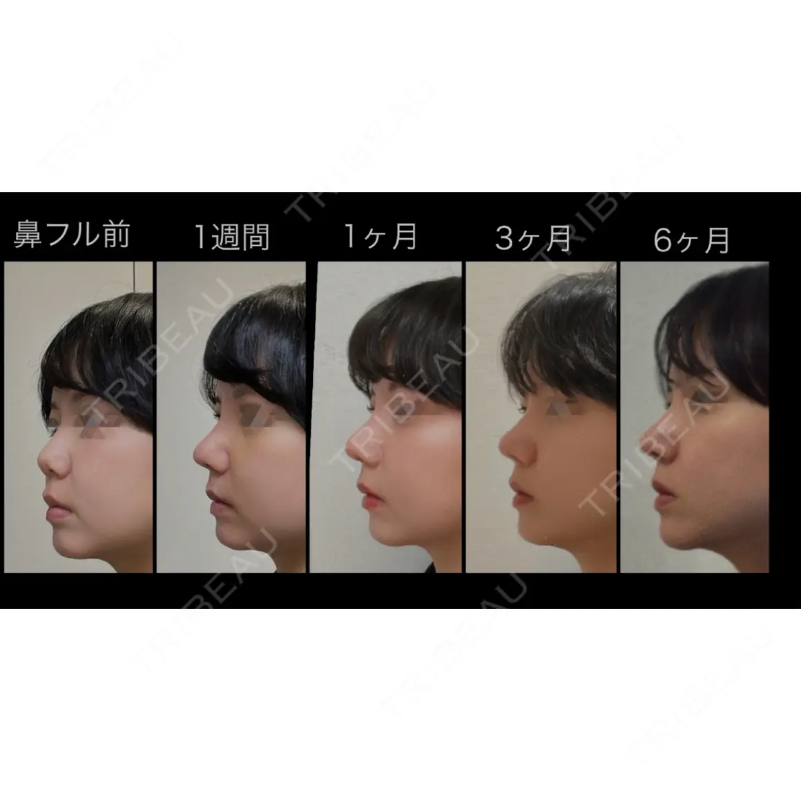 隆鼻術 / 鼻尖形成（切開） / 鼻中隔延長（切開） / 骨切幅寄せ / ワシ鼻修正・ハンプ切除 LUHO（ルホ）美容外科 AFTER
