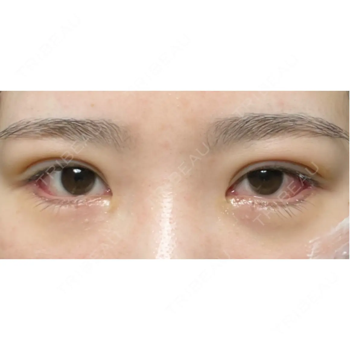 二重埋没 / タレ目形成・グラマラスライン（切開） エターナル美容クリニック AFTER