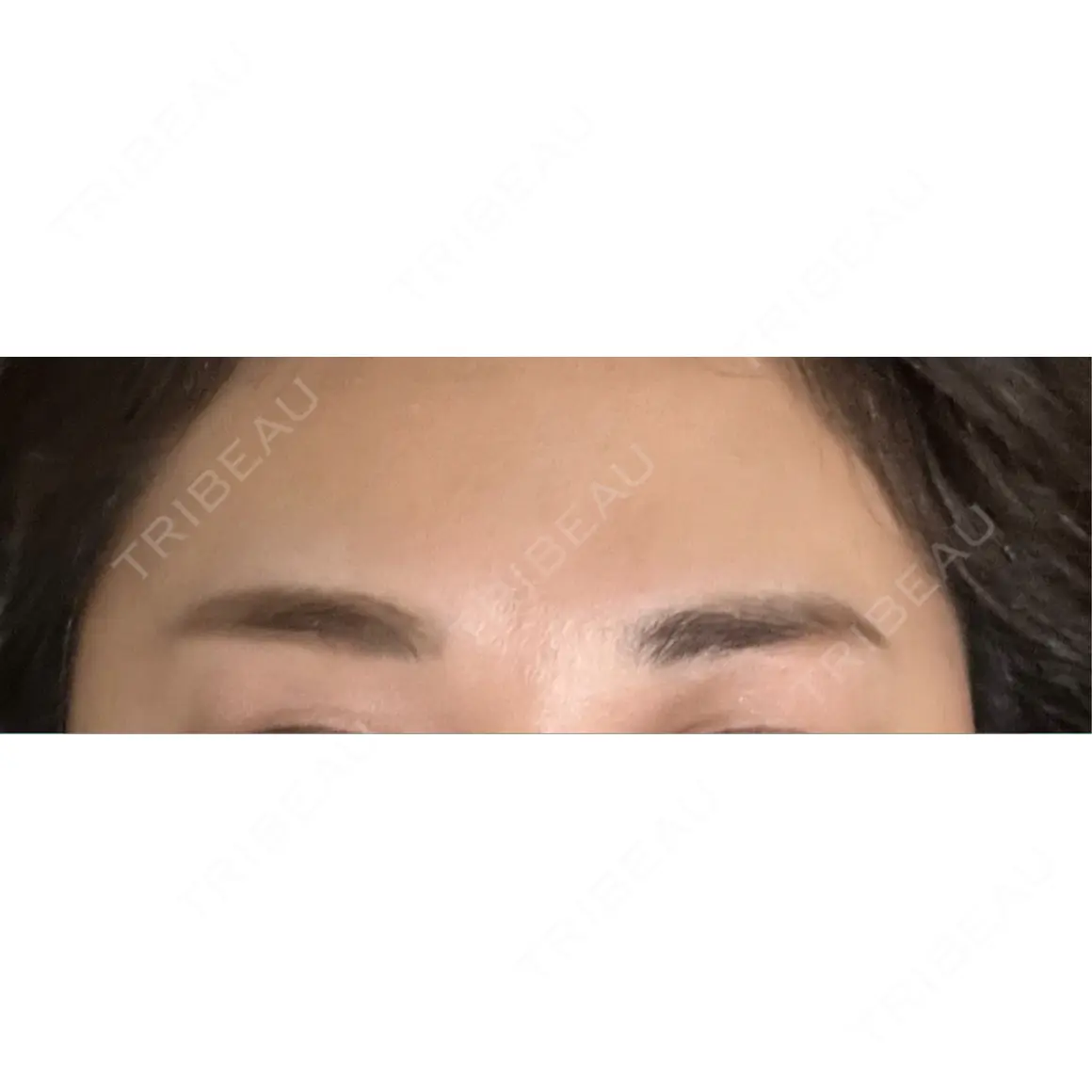 ボトックス（眉間） 浅草橋三丁目クリニック AFTER