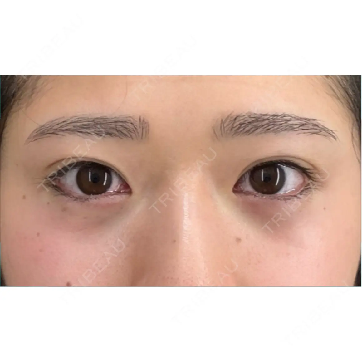 クマ治療 / 下まぶたの脂肪取り EMMO FACE CLINIC 東京三田院 DAY 0
