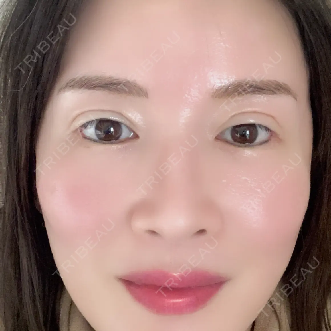 脂肪吸引（脚） / 脂肪吸引（お尻） / 脂肪注入（輪郭） Mods Clinic（モッズクリニック） 名古屋院 AFTER