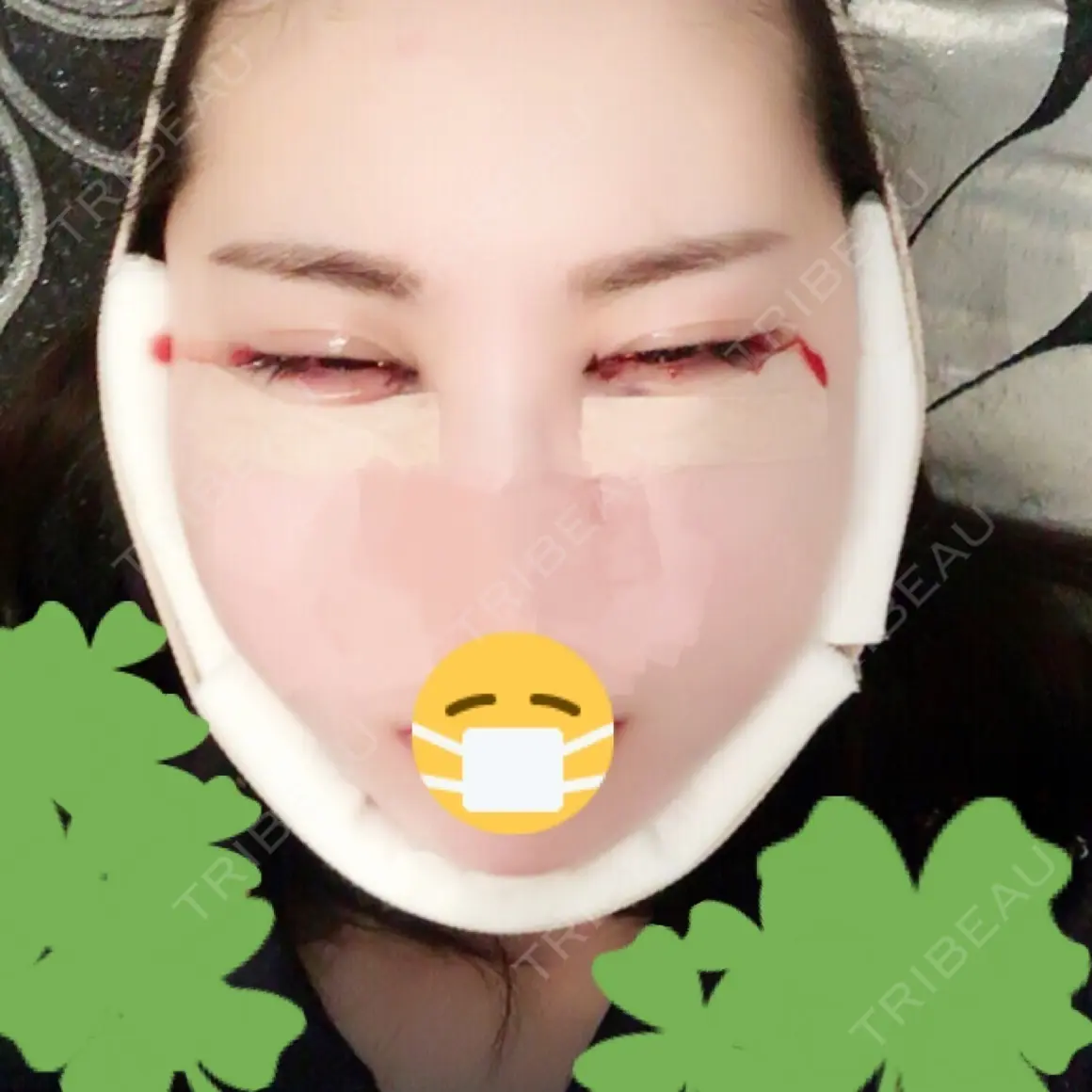 目頭切開 / 脂肪吸引（顔） / ヒアルロン酸注入（涙袋） ジュエリー美容外科 DAY 0