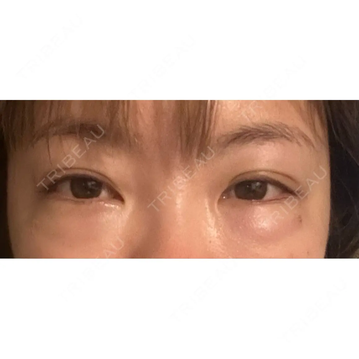 クマ治療 EMMO FACE CLINIC 東京三田院 DAY 0