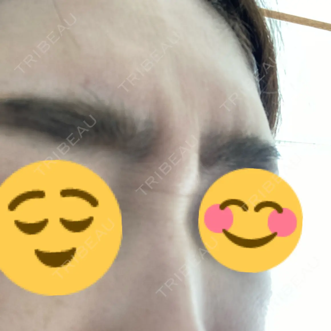 ボトックス（眉間） PRO CLINIC プロクリニック 銀座院 AFTER