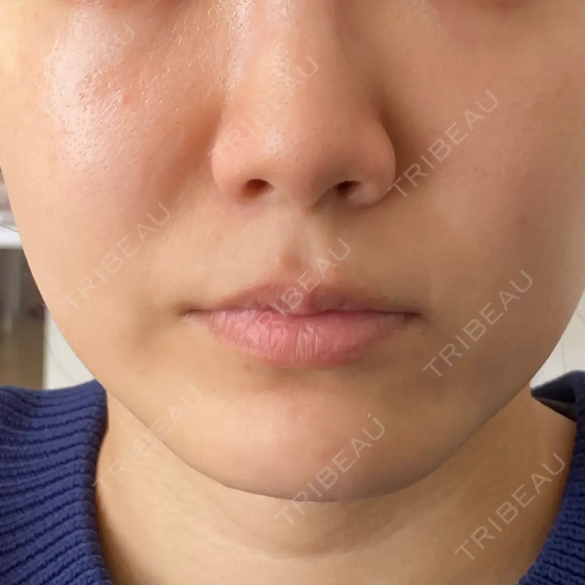 脂肪溶解注射（顔） WellnessPlus Clinic 【ウェルネスプラスクリニック】 AFTER
